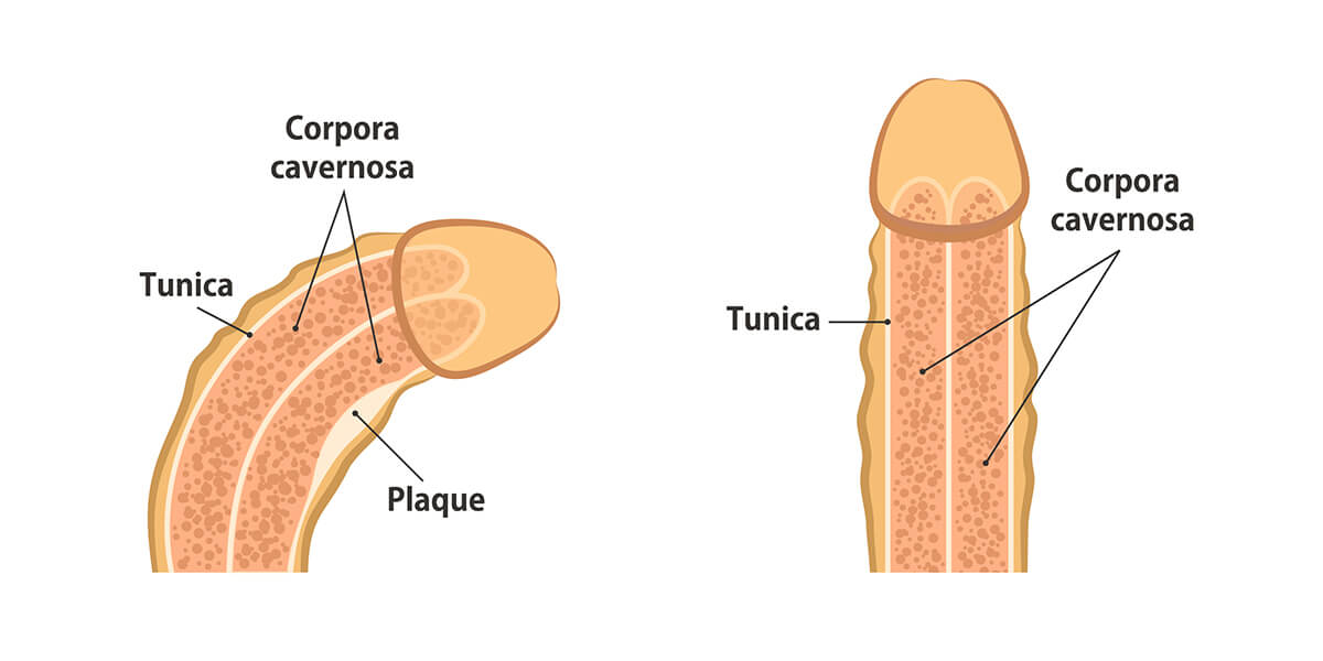 patologia pene