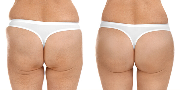 prima e dopo glutei liposcultura