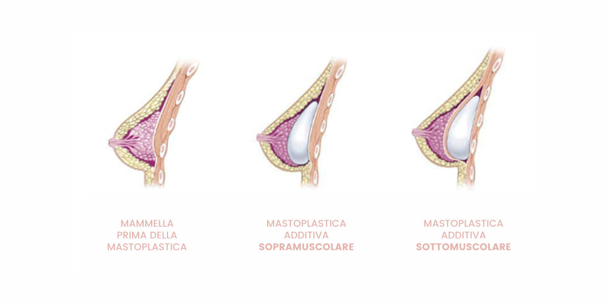 tipologie mastoplastica