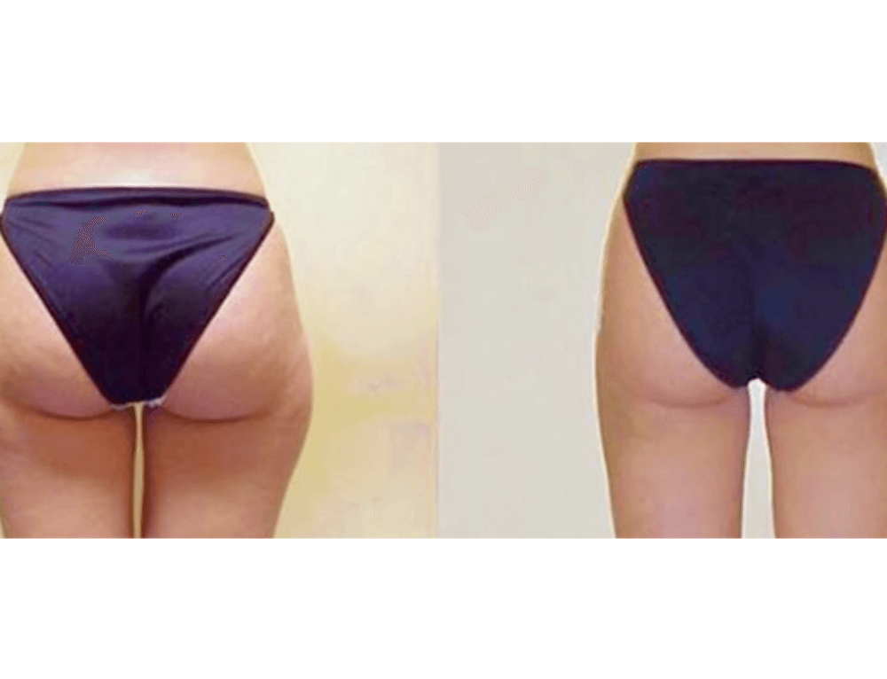 липолиз лица. наружная поверхность бедер (зона "галифе"). пластическая операция на внутреннюю часть бедра. липосакция бедер ваш бренд тут. вибрационная липосакция живота.