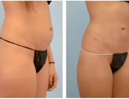 LIPOSCULTURA