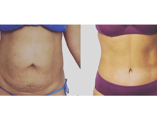 LIPOSCULTURA