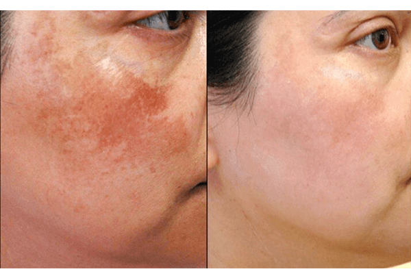 peeling chimico acne