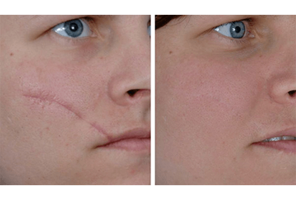 curare cicatrici acne