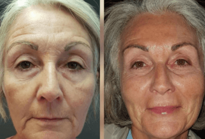 Prima e dopo biolifting