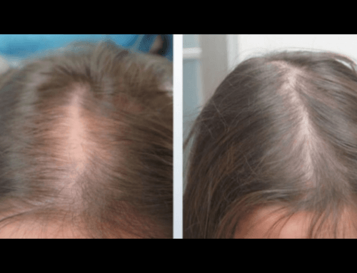 PRP capelli prima e dopo
