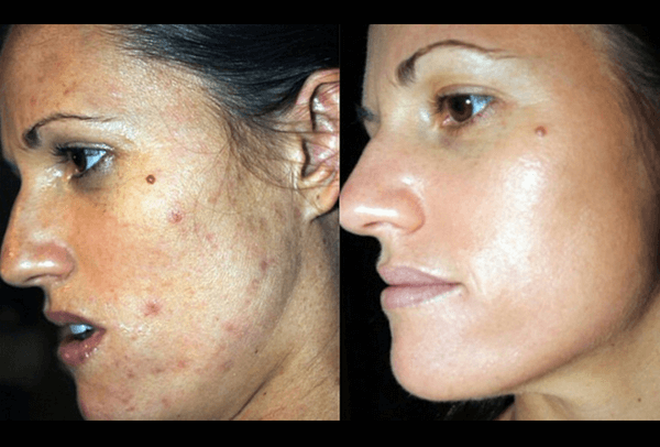 peeling chimico viso