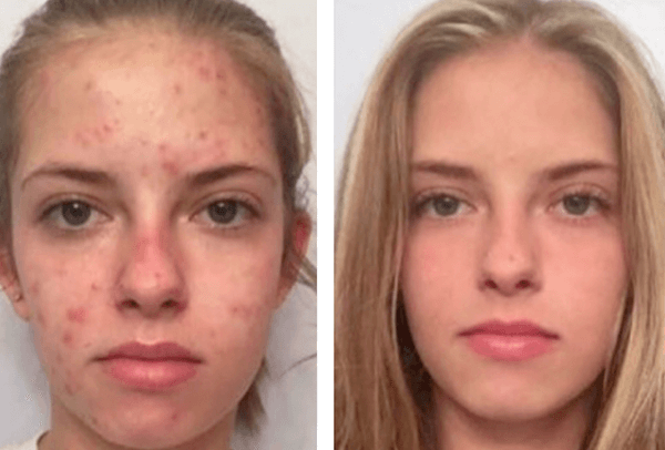 peeling viso acne