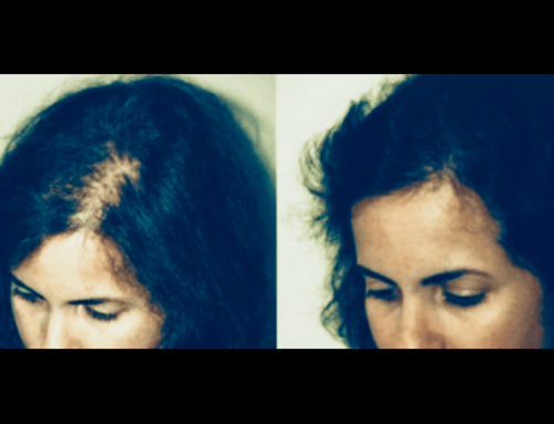 Trattamento caduta capelli donna con PRP