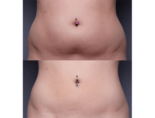 LIPOSCULTURA