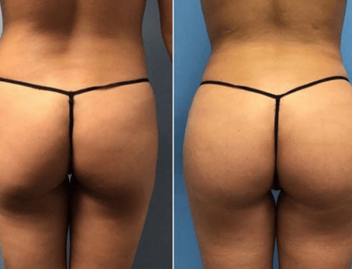 Liposcultura e lipofilling