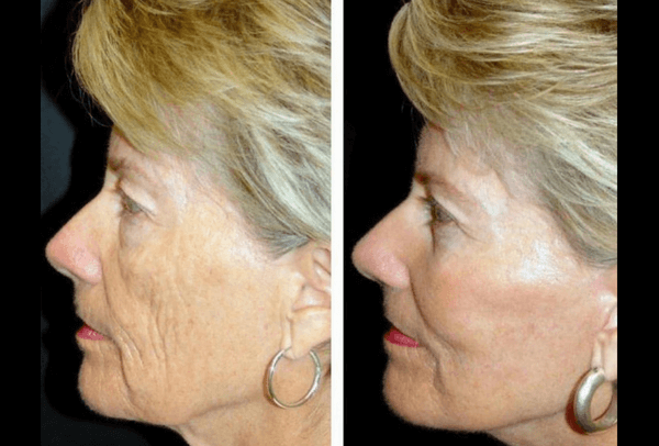 laser per ringiovanire il viso
