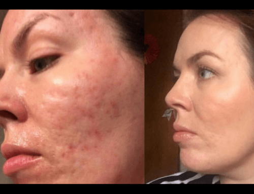 Peeling chimico contro cicatrici acne