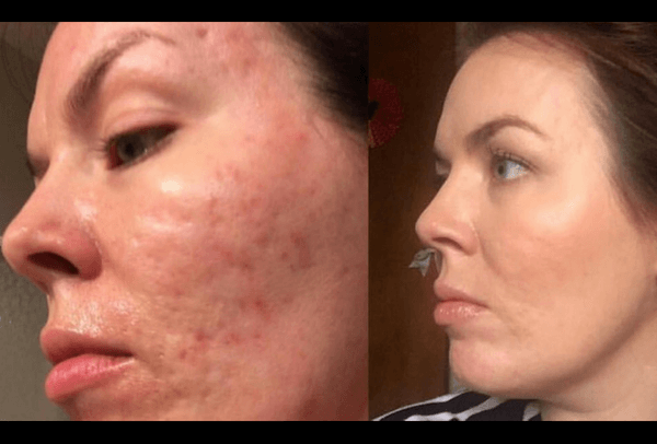 trattamenti per cicatrici acne