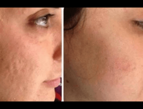 PRP dermatologico viso