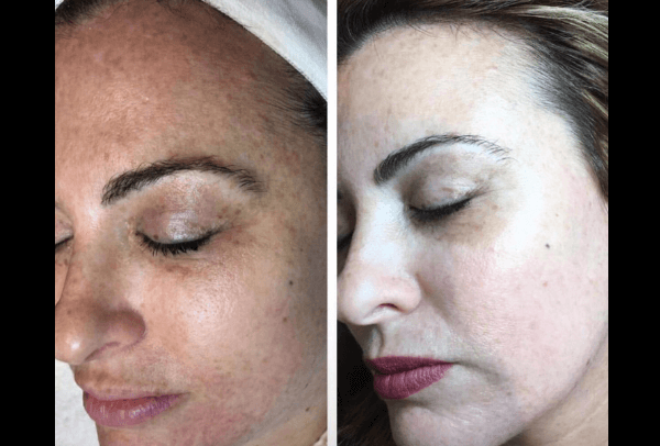 trattamenti viso laser