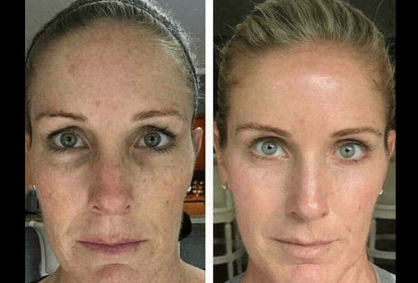 trattamento laser macchie viso