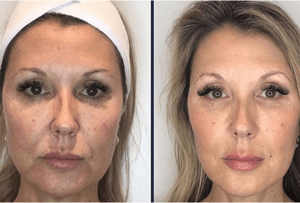 laser ringiovanimento viso